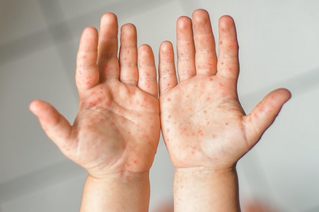 HFMD infection