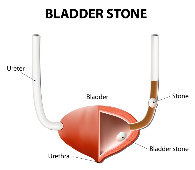 bladder stone