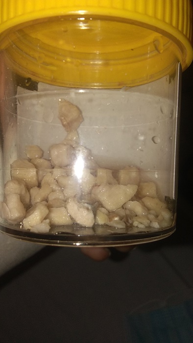bladder stones