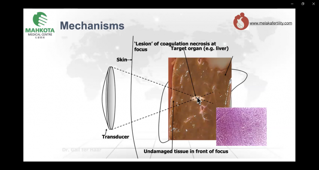 Dr. S. Selva explaining the mechanisms of HIFU treatment