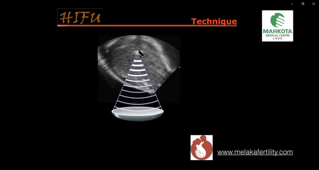 Dr. S. Selva explaining the techniques of HIFU treatment