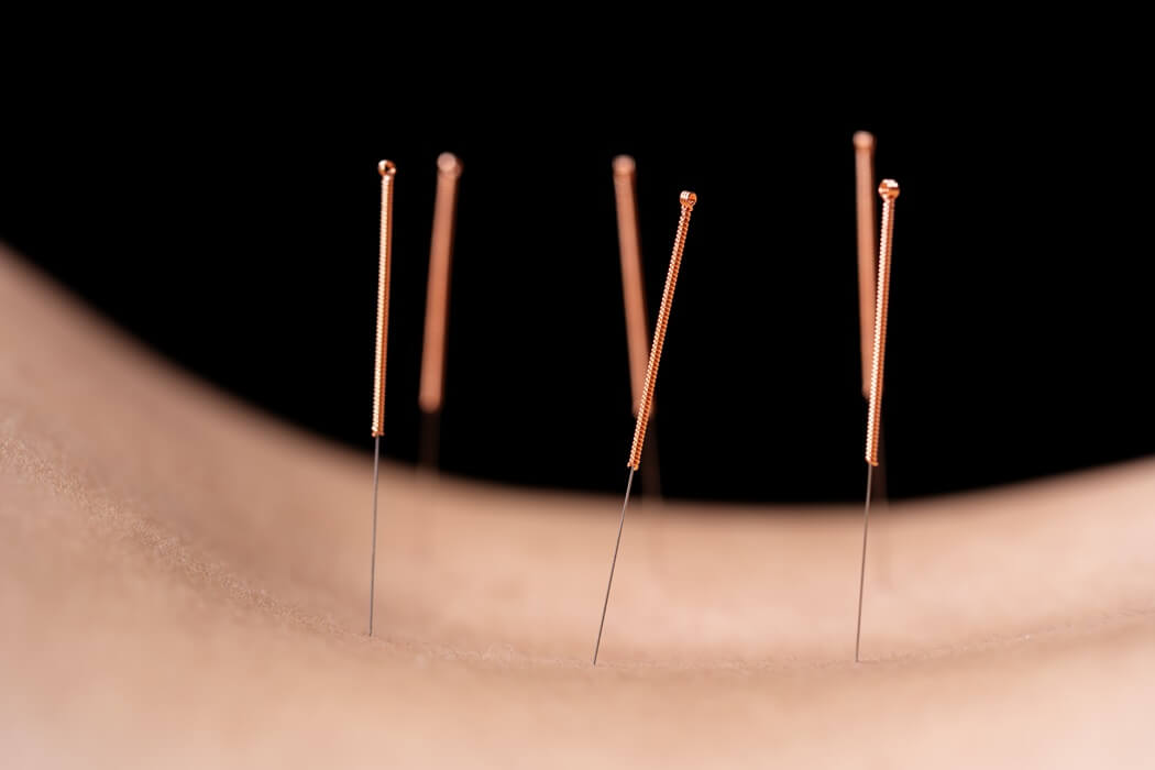 aupuncture