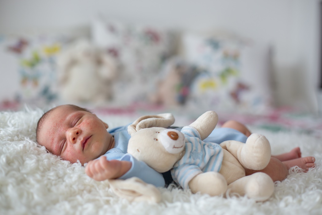 Little newborn baby sleeping, baby with scin rash