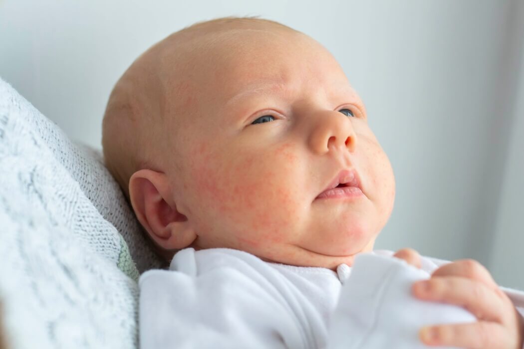baby having eczema