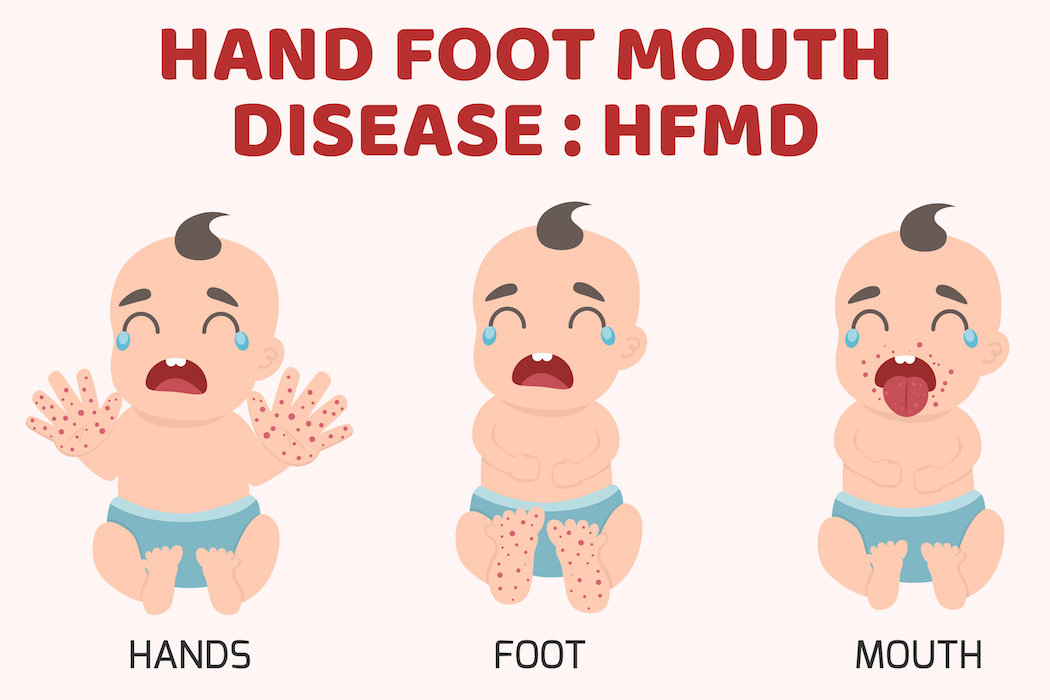HFMD children infected. Hand-foot-mouth disease Infographics with symptoms. cartoon health concept vector illustration.