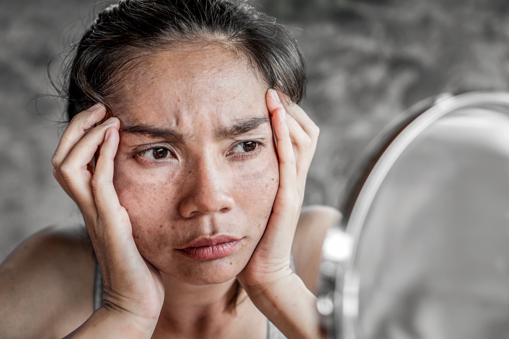 sad Asian woman having skin problem