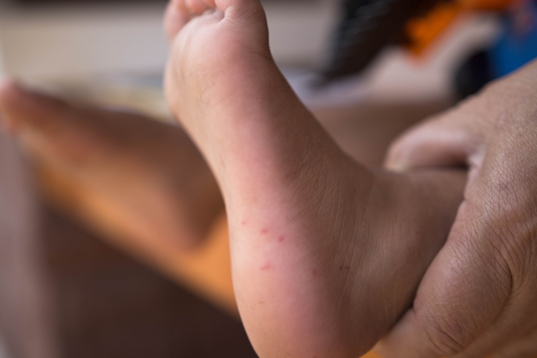 Hand foot mouth disease in child