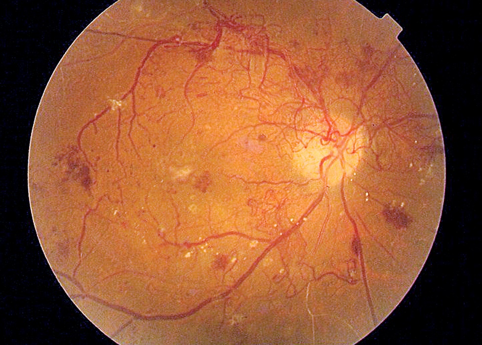 A photo featuring a proliferative diabetic retinopathy